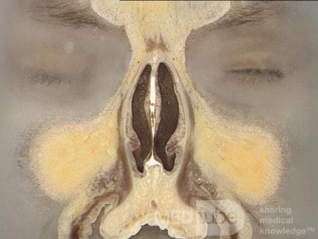 Anatomie coronale du nez et des sinus paranasaux: tranche 1