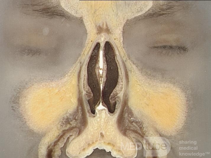 Anatomie coronale du nez et des sinus paranasaux: tranche 1