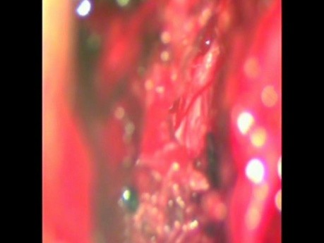 Microdiscectomie lombaire