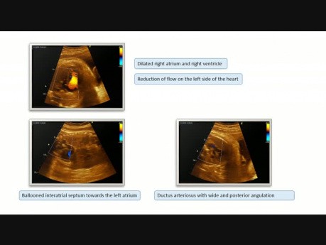 Foramen ovale restrictif dans la période fœtale et le processus post-natal