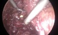 Prostatectomie Radicale Laparoscopique avec Préservation du Retzius 