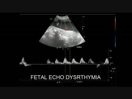 Dystrthymie de l'écho fœtal