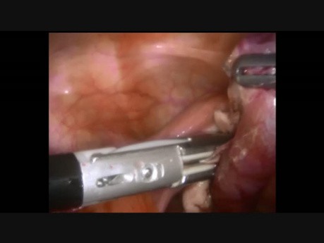 Salpingectomie en raison de torsion de trompe de Fallope