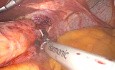 Laparoscopic Nissen Fundoplication (annotated) 