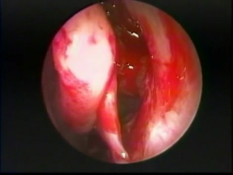 Sinusite fongique allergique - traitement endoscopique