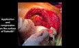 TachoSil pour une Hémostase et une Etanchéité Suffisantes lors d'une Double Transplantation Pulmonaire avec ECMO V-V