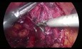 Excision mésocolique complète par laparoscopie (CME) - Hémicolectomie droitexcision mésocolique complète,
