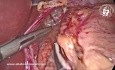 Chirurgie du RGO : Fundoplicatue de Nissen Laparoscopique
