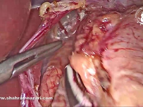 Chirurgie du RGO : Fundoplicatue de Nissen Laparoscopique