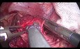 Myotomie de Heller par voie laparoscopique et fundoplicature de Dor