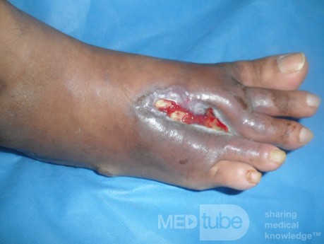 L'ulcère du pied diabétique avec l'ostéomyélite