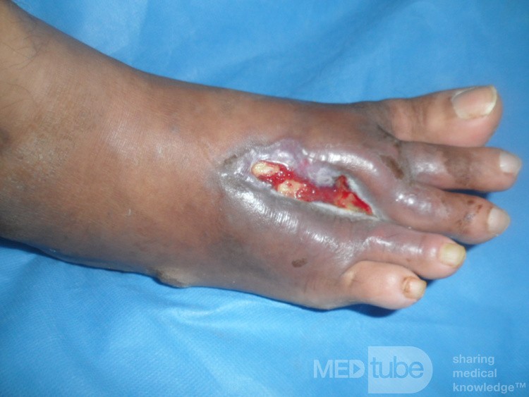 L'ulcère du pied diabétique avec l'ostéomyélite
