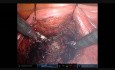 Prostatectomie laparoscopique robot-assistée épargnant le Retzius