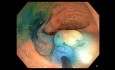 Mucosectomie endoecopique (EMR) à l'anse chaude d'un polype rectal