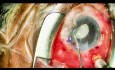 Remplacement de Lentille Intra-Oculaire (LIO) avec Fixation de Yamane, 2ème Partie