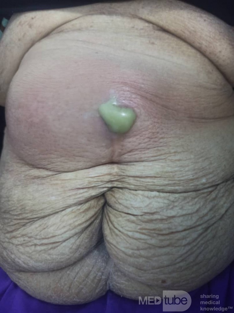 Abcès de la paroi abdominale