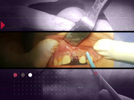 Placement d'implant frais