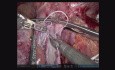 Transplantaation Hépatique Robotisée à Partir d'un Donneur Décédé