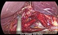 Valve Anti Reflux Postérieure Type TOUPET