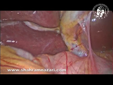 L'Anatomie du Sillon du Processus Caudé (Sillon de Rouvière) vue lors d'une Cholécystectomie Laparoscopique