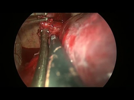 Résection d'un énorme kyste bronchogénique par chirurgie thoracique vidéo-assistée (CTVA) à l'incision unique
