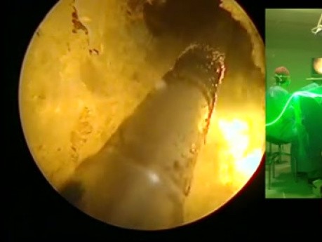 Photovaporisation de la prostate hypertrophiée au laser Greenlight