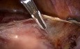 Fibrome de Taille Equivalente à 20 SA