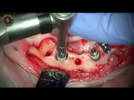 Extraction d'implants dentaires et insertion immédiate d'implants combinés avec GBR
