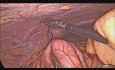 Résection de la tumeur neuroendocrine iléale par laparoscopie
