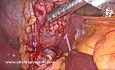 Cholécystectomie Laparoscopique - Dissection de l'Artère et du Canal 