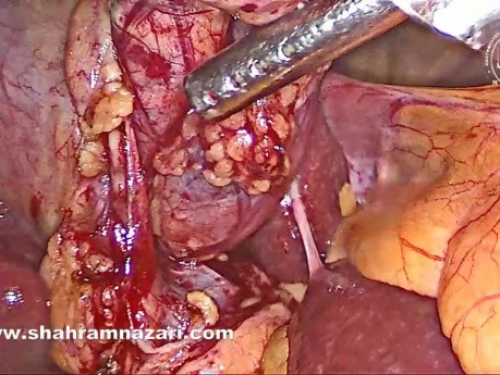 Cholécystectomie Laparoscopique - Dissection de l'Artère et du Canal 