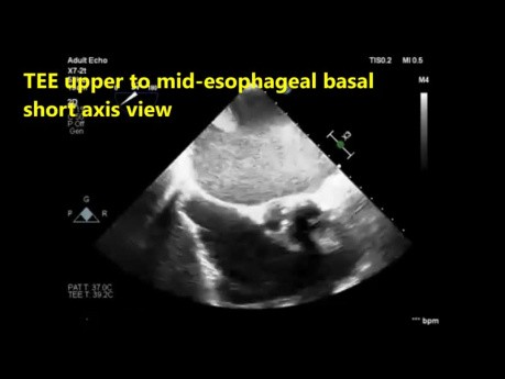 Quiz sur l'échocardiographie transœsophagienne (ETO)