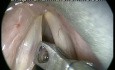 Ablation Accidentelle d'un Polype des Plis Vocaux - Excision Parfaite