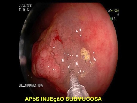 Pré-incision lors de la Mucosectomie des Lésions Colorectales Planes Difficiles