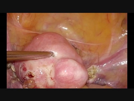 Hystérectomie, un cas simple. Ablation de l'artère utérine.