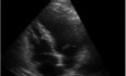 Échographie cardiaque - anomalie du mouvement de la paroi apicale du ventricule gauche, ancien infarctus du myocarde antérieur 