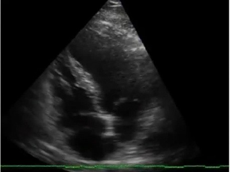 Échographie cardiaque - anomalie du mouvement de la paroi apicale du ventricule gauche, ancien infarctus du myocarde antérieur 