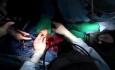 Transplantation Cardiaque avec Renforcement des Anastomoses avec Feutre en Téflon