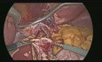 Énucléation du léiomyome de l'œsophage par voie laparoscopique