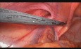 Vue laparoscopique - Anatomie de l'aine (orifice musculo-pectinéal)