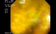 Diagnostic et Traitement des Lésions de la Voie Biliaire Distale par Echoendoscopie et CPRE