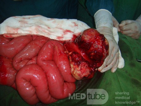 une occlusion intestinale au cours d'un lymphome.