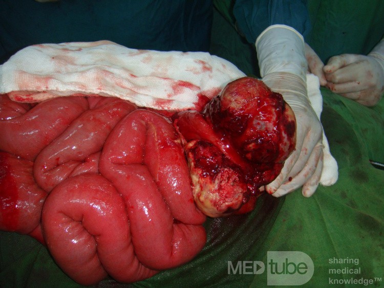 une occlusion intestinale au cours d'un lymphome. • Image • Site ...