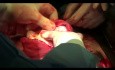 Myomectomie. Élimination des gros fibromes avec coupure temporaire des artères utérines