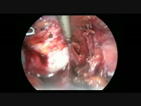 Cystadénome mucineux bilatéral - prise en charge laparoscopique