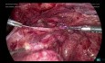 Salpingectomie gauche laparoscopique en raison d'hydrosalpinx et une libération des adhérences - Partie 4