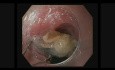 Extraction de corps étrangers oesophagiens dans le tractus gastro-intestinal supérieur