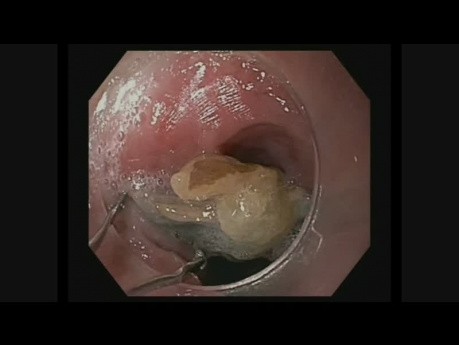 Extraction de corps étrangers oesophagiens dans le tractus gastro-intestinal supérieur