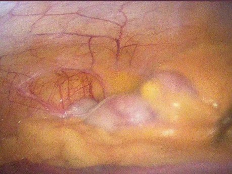 Appendicite Aiguë, Grossesse en Cours, Hernie Inguinale Oblique Droite et Antécédants de Cholécystectomie Laparoscopique