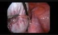 Traitement laparoscopique d'un gros tératome
